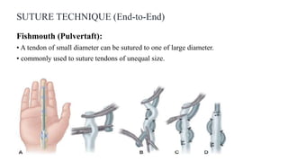 SUTURE TECHNIQUE (End-to-End)
Fishmouth (Pulvertaft):
• A tendon of small diameter can be sutured to one of large diameter.
• commonly used to suture tendons of unequal size.
 