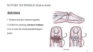 SUTURE TECHNIQUE (End-to-End)
• Tendon and skin sutured together
• Useful for suturing extensor tendons
over or near the metacarpophalangeal
joints
Roll-Stitch
 
