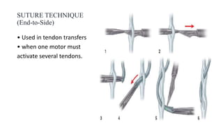 SUTURE TECHNIQUE
(End-to-Side)
• Used in tendon transfers
• when one motor must
activate several tendons.
 