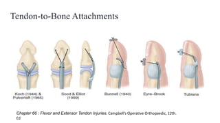 Tendon-to-Bone Attachments
Chapter 66 : Flexor and Extensor Tendon Injuries. Campbell’s Operative Orthopaedic, 12th.
Ed
 