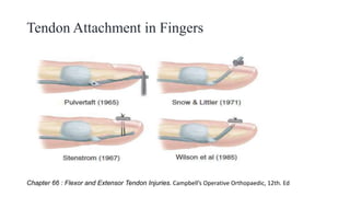 Tendon Attachment in Fingers
Chapter 66 : Flexor and Extensor Tendon Injuries. Campbell’s Operative Orthopaedic, 12th. Ed
 