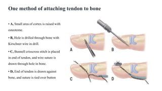 One method of attaching tendon to bone
• A, Small area of cortex is raised with
osteotome.
• B, Hole is drilled through bone with
Kirschner wire in drill.
• C, Bunnell crisscross stitch is placed
in end of tendon, and wire suture is
drawn through hole in bone.
• D, End of tendon is drawn against
bone, and suture is tied over button
 