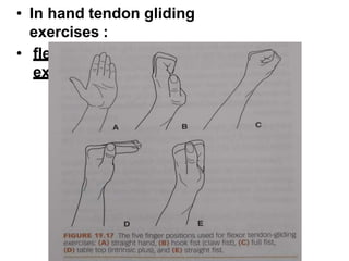 • In hand tendon gliding
exercises :
• flexor tendon gliding
exercise
 