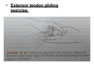 • Extensor tendon gliding
exercise:
 
