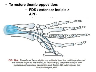 • To restore thumb opposition:
• FDS / extensor indicis >
APB
 