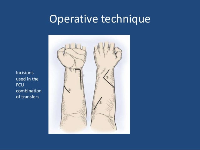 Tendon Transfer For Radial Nerve Palsy