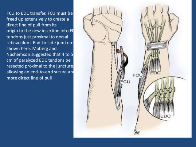 Tendon Transfer For Radial Nerve Palsy