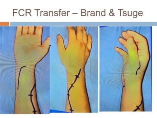 Fcr Tendon Incision Tendon transfers for radial nerve palsy | PPT