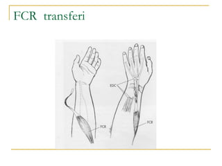 Fcr Tendon Incision TENDON TRASFERLERİTENDON TRASFERLERİ.ppt