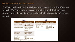Tendon transfer for ulnar nerve
Neighbouring healthy tendon is brought to replace the action of the lost
intrincic . Tendon chosen is passed through the lumbrical canal and
attached to the dorsal digital expansion which brings action of the lost
intrinsic.
 