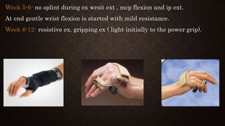 Week 5-6- no splint during ex wrsit ext , mcp flexion and ip ext.
At end gentle wrist flexion is started with mild resistance.
Week 6-12- resistive ex, gripping ex ( light initially to the power grip).
 