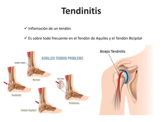 Tendinitis
 Inflamación de un tendón
 Es sobre todo frecuente en el Tendón de Aquiles y el Tendón Bicipital
 