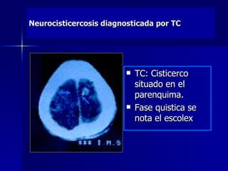 Neurocisticercosis diagnosticada por TC




                           TC: Cisticerco
                            situado en el
                            parenquima.
                           Fase quistica se
                            nota el escolex
 