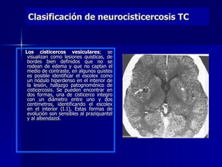 Clasificación de neurocisticercosis TC


Los cisticercos vesiculares; se
 visualizan como lesiones quisticas, de
 bordes bien definidos que no se
 rodean de edema y que no captan el
 medio de contraste, en algunos quistes
 es posible identificar el escolex como
 un nódulo hiperdenso en el interior de
 la lesión, hallazgo patognomónico de
 cisticercosis. Se pueden encontrar en
 dos formas, una de cisticerco integro
 con un diámetro entre uno y dos
 centímetros, identificando el escolex
 en el interior (I.1), Estas formas de
 evolución son sensibles al praziquantel
 y al albendazol.
 