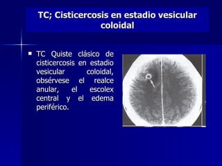 TC; Cisticercosis en estadio vesicular
                   coloidal


   TC Quiste clásico de
    cisticercosis en estadio
    vesicular       coloidal,
    obsérvese el realce
    anular,     el   escolex
    central y el edema
    periférico.
 