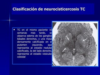 Clasificación de neurocisticercosis TC




   TC en el mismo paciente 10
    semanas       mas     tarde,   se
    observa edema de los ganglios
    básales derechos, y una masa
    densamente calcificada en el
    putamen        izquierdo,    que
    representa al estadio nodular
    calcificado, la del lado derecho,
    representa al estadio vesicular
    coloidal
 