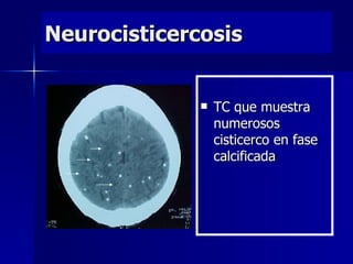 Neurocisticercosis


                 TC que muestra
                  numerosos
                  cisticerco en fase
                  calcificada
 