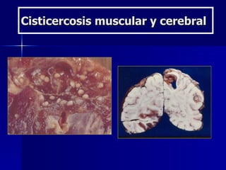 Cisticercosis muscular y cerebral
 