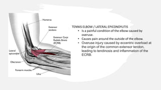 TENNIS ELBOW / LATERAL EPICONDYLITIS
• Is a painful condition of the elbow caused by
overuse.
• Causes pain around the outside of the elbow.
• Overuse injury caused by eccentric overload at
the origin of the common extensor tendon,
leading to tendinosis and inflammation of the
ECRB.
 