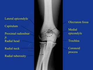 Lateral epicondyle 
Capitulum 
Proximal radioulnar 
jt. 
Radial head 
Radial neck 
Radial tuberosity 
Olecranon fossa 
Medial 
epicondyle 
Trochlea 
Coronoid 
process 
 