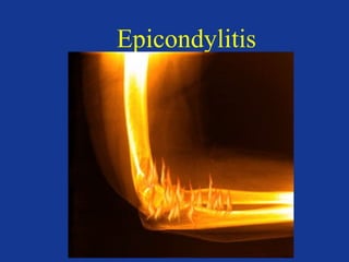 Epicondylitis 
 