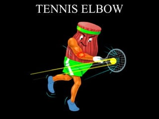 TENNIS ELBOW 
 