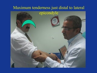 Maximum tenderness just distal to lateral 
epicondyle 
 