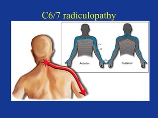 C6/7 radiculopathy 
 