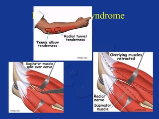Radial tunnel syndrome 
 
