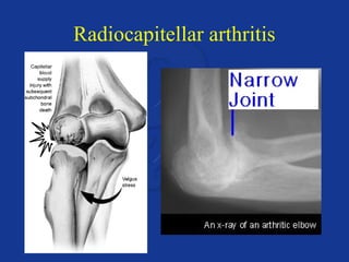 Radiocapitellar arthritis 
 