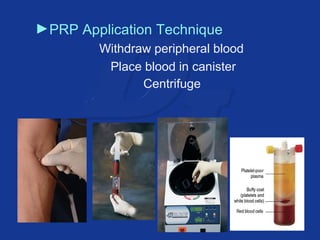►PRP Application Technique 
Withdraw peripheral blood 
Place blood in canister 
Centrifuge 
 