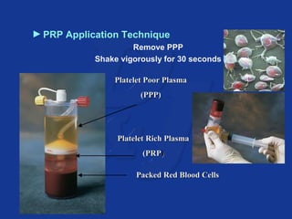 ►PRP Application Technique 
Remove PPP 
Shake vigorously for 30 seconds 
PPllaatteelleett PPoooorr PPllaassmmaa 
((PPPPPP)) 
PPllaatteelleett RRiicchh PPllaassmmaa 
((PPRRPP)) 
PPaacckkeedd RReedd BBlloooodd CCeellllss 
 