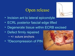 Open release 
• Incision ant to lateral epicondyle 
• ECRL posterior fascial edge lifted 
• Degenerate tissue within ECRB excised 
• Defect firmly repaired 
– +/- suture anchors 
• ?Decompression of PIN 
 