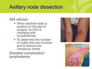Breast Cancer: Dr. Patty Tenofsky | PPT