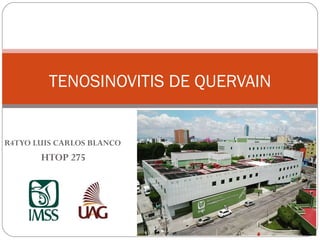 TENOSINOVITIS DE QUERVAIN
R4TYO LUIS CARLOS BLANCO
HTOP 275
 