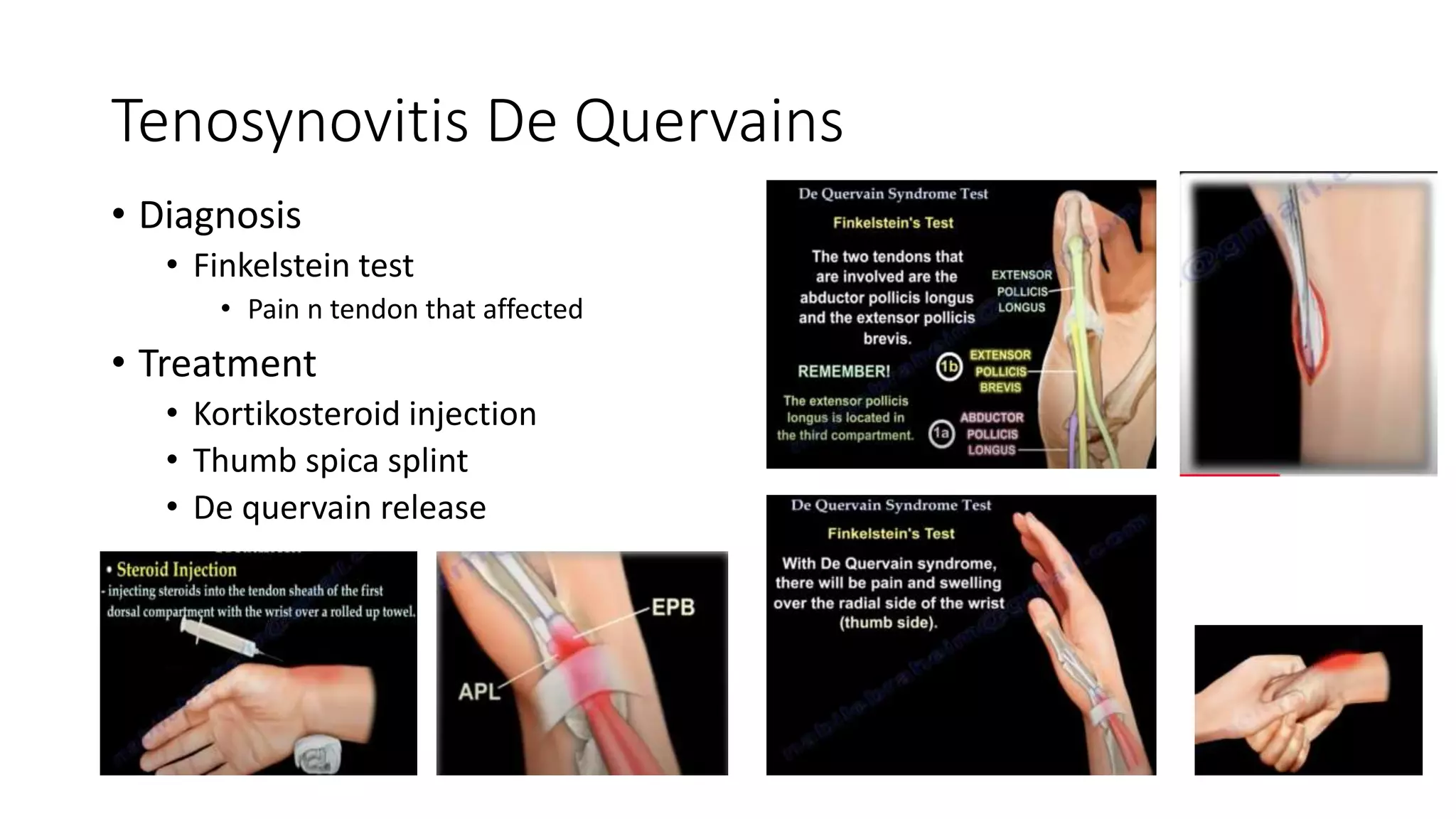 Tenosynovitis De Quervains.pptx