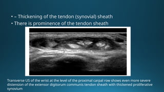 Sheathing Injury Comprehensive Overview of Tenosynovitis: Causes, Diagnosis, and Imaging ...