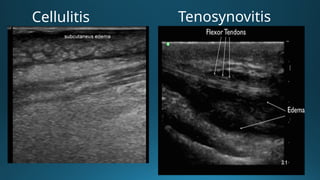 Sheathing Injury Comprehensive Overview of Tenosynovitis: Causes, Diagnosis, and Imaging ...