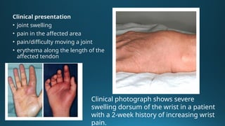 Sheathing Injury Comprehensive Overview of Tenosynovitis: Causes, Diagnosis, and Imaging ...