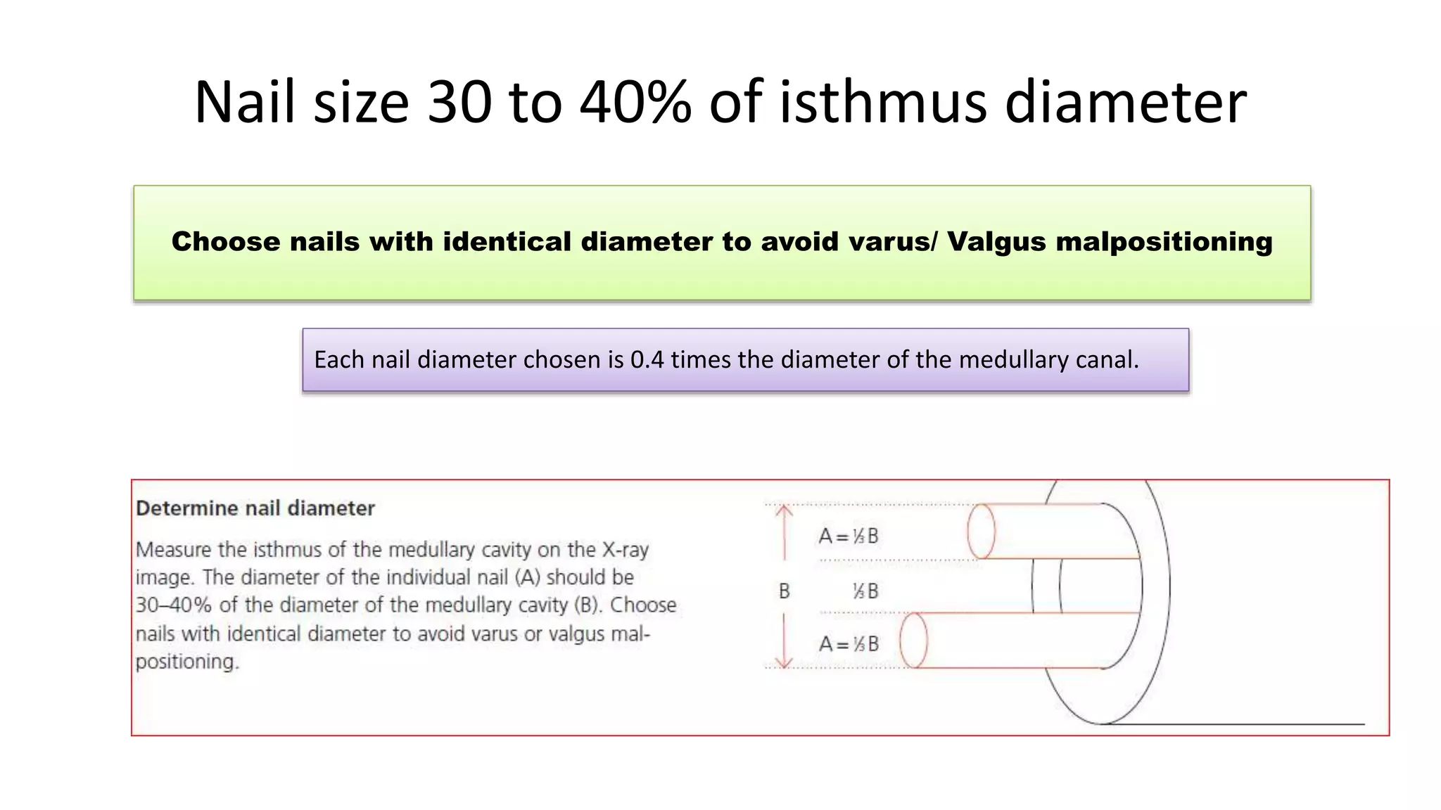 Nail size 30 to 40% of isthmus diameter
Choose nails with identical diameter to avoid varus/ Valgus malpositioning
Each nail diameter chosen is 0.4 times the diameter of the medullary canal.
 
