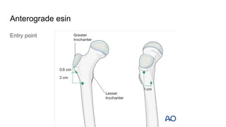 Anterograde esin
Entry point
 