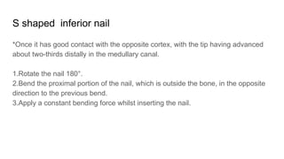 S shaped inferior nail
*Once it has good contact with the opposite cortex, with the tip having advanced
about two-thirds distally in the medullary canal.
1.Rotate the nail 180°.
2.Bend the proximal portion of the nail, which is outside the bone, in the opposite
direction to the previous bend.
3.Apply a constant bending force whilst inserting the nail.
 