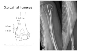 3.proximal humerus
 