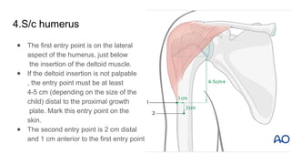 4.S/c humerus
● The first entry point is on the lateral
aspect of the humerus, just below
the insertion of the deltoid muscle.
● If the deltoid insertion is not palpable
, the entry point must be at least
4-5 cm (depending on the size of the
child) distal to the proximal growth
plate. Mark this entry point on the
skin.
● The second entry point is 2 cm distal
and 1 cm anterior to the first entry point oin
 