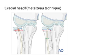 5.radial head#(metaizeau technique)
 