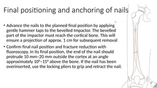 Cortexed Nail TENS Nailing in Children: Tips and Tricks AZHAR.pptx