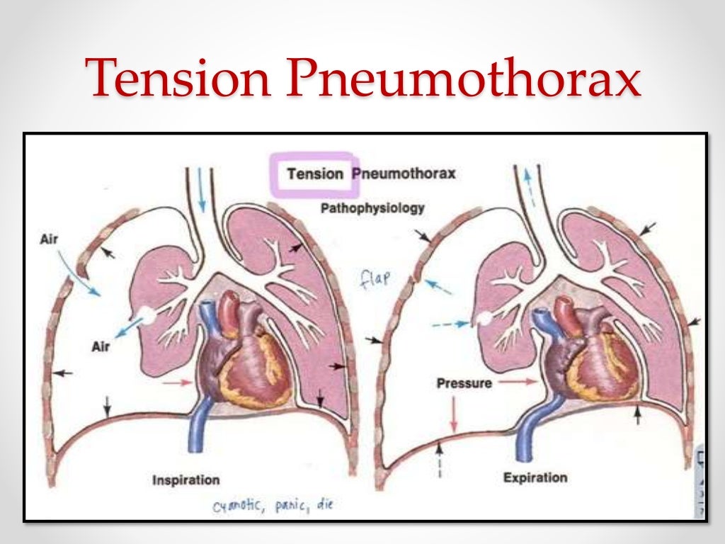 Tension Pneumothorax
