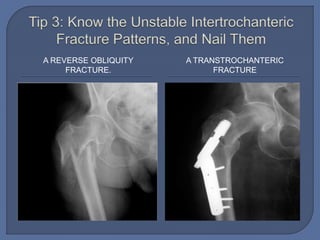 A REVERSE OBLIQUITY
FRACTURE.
A TRANSTROCHANTERIC
FRACTURE
 