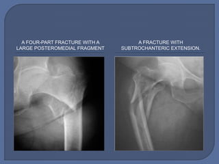 A FOUR-PART FRACTURE WITH A
LARGE POSTEROMEDIAL FRAGMENT
A FRACTURE WITH
SUBTROCHANTERIC EXTENSION.
 
