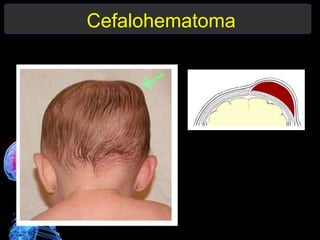 Cefalohematoma
 